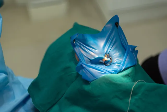 حشوات تجميلية مباشرة